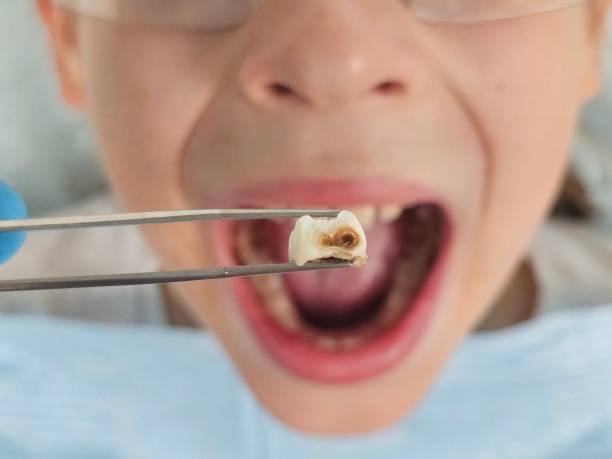 Best Emergency Tooth Extraction in Hillsboro, WI